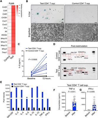 Thymic stromal lymphopoietin-stimulated CD4+ T cells induce senescence in advanced breast cancer